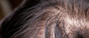 perdita dei capelli cute